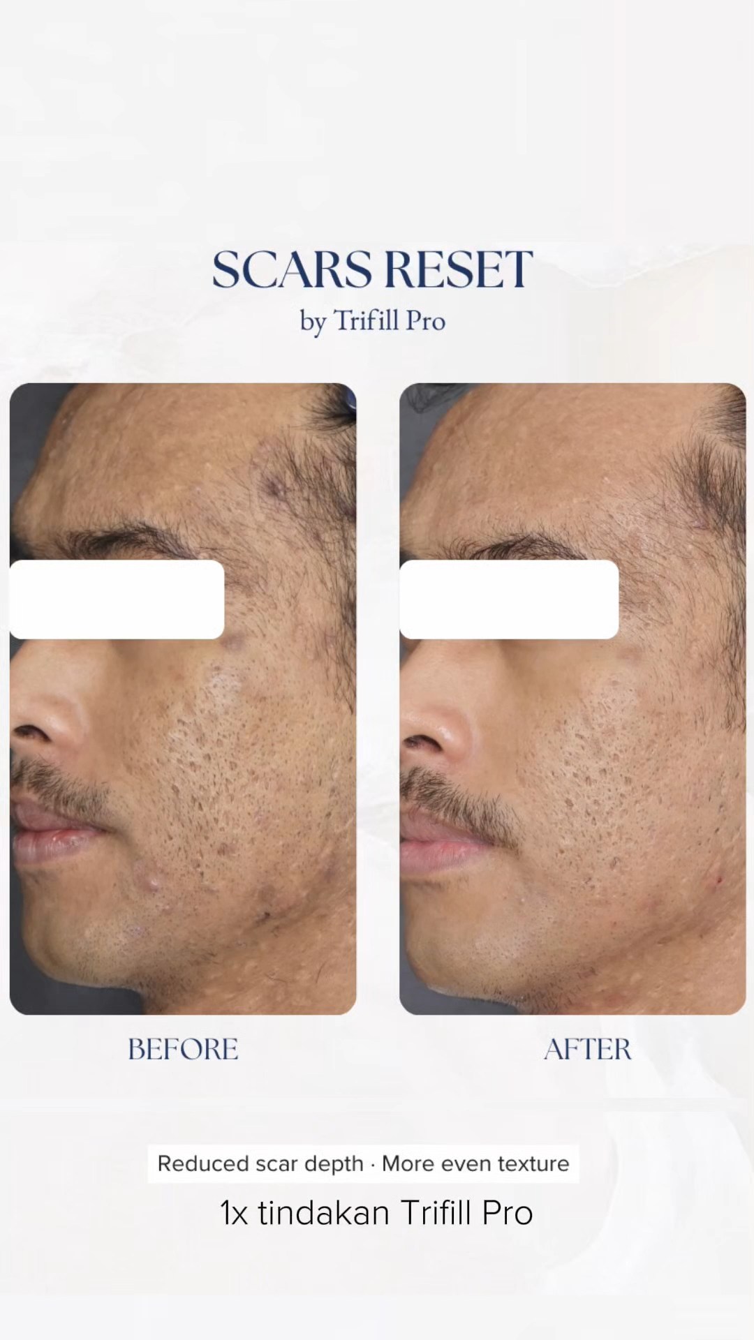 Trifill Scars Reset TIUwoo
