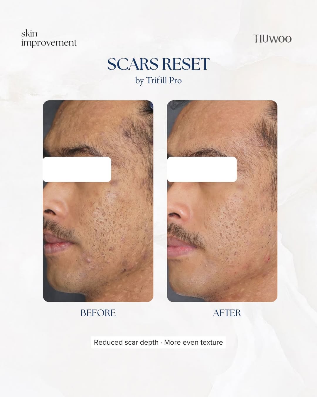 Before After Trifill Pro