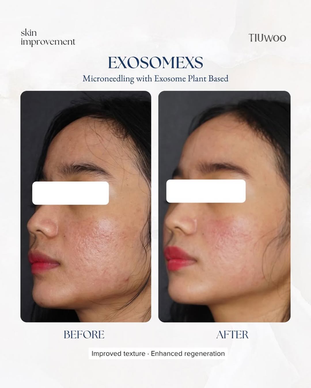 ExosomeXS Before After