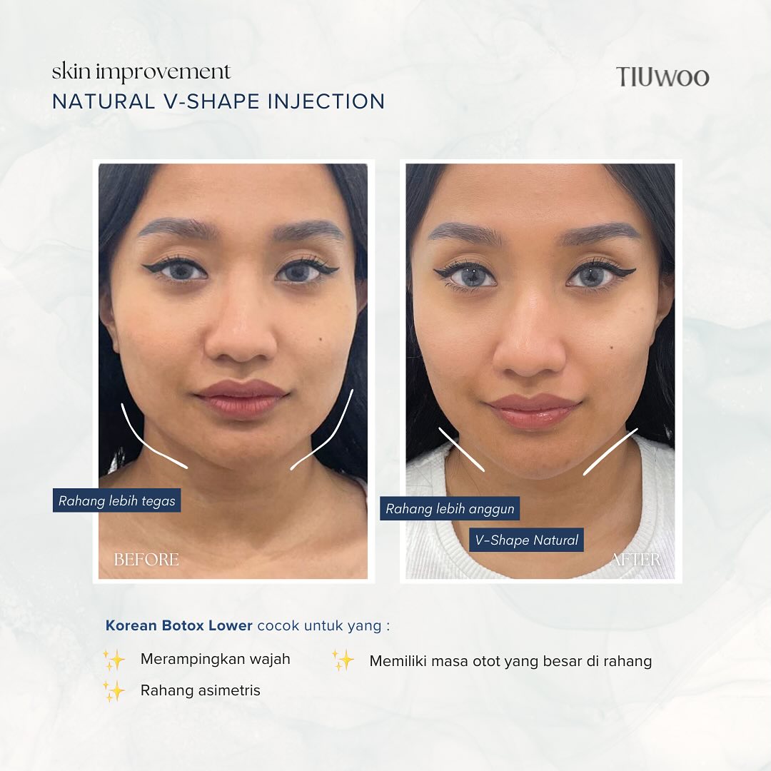 Koretox Lower Before After