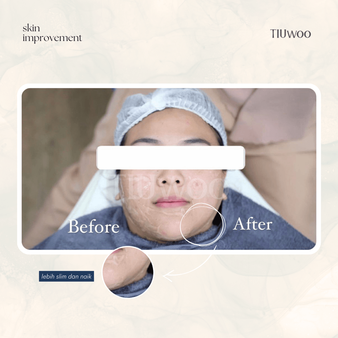 Meso Lifting Before After