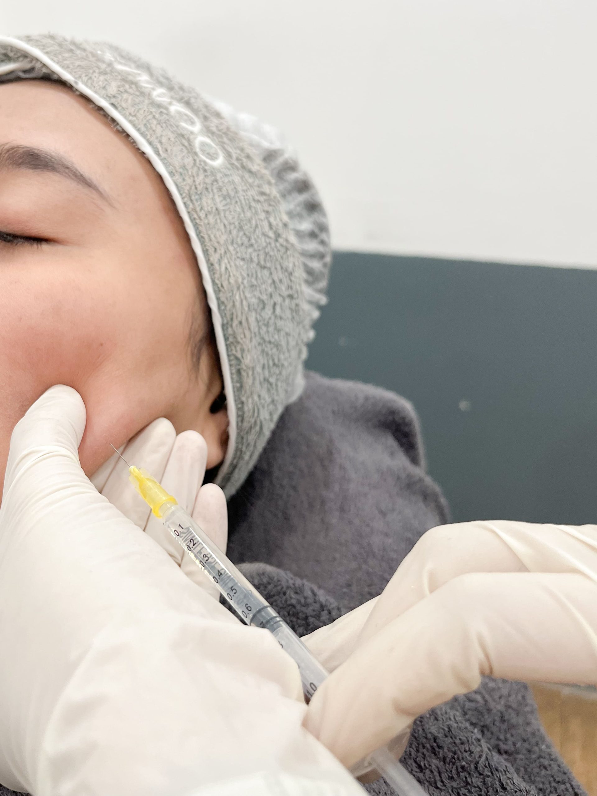 Treatment Meso Lifting ini berfungsi mengangkat & mengencangkan kulit kendur serta menghilangkan lemak wajah & double chin secara permanen.
