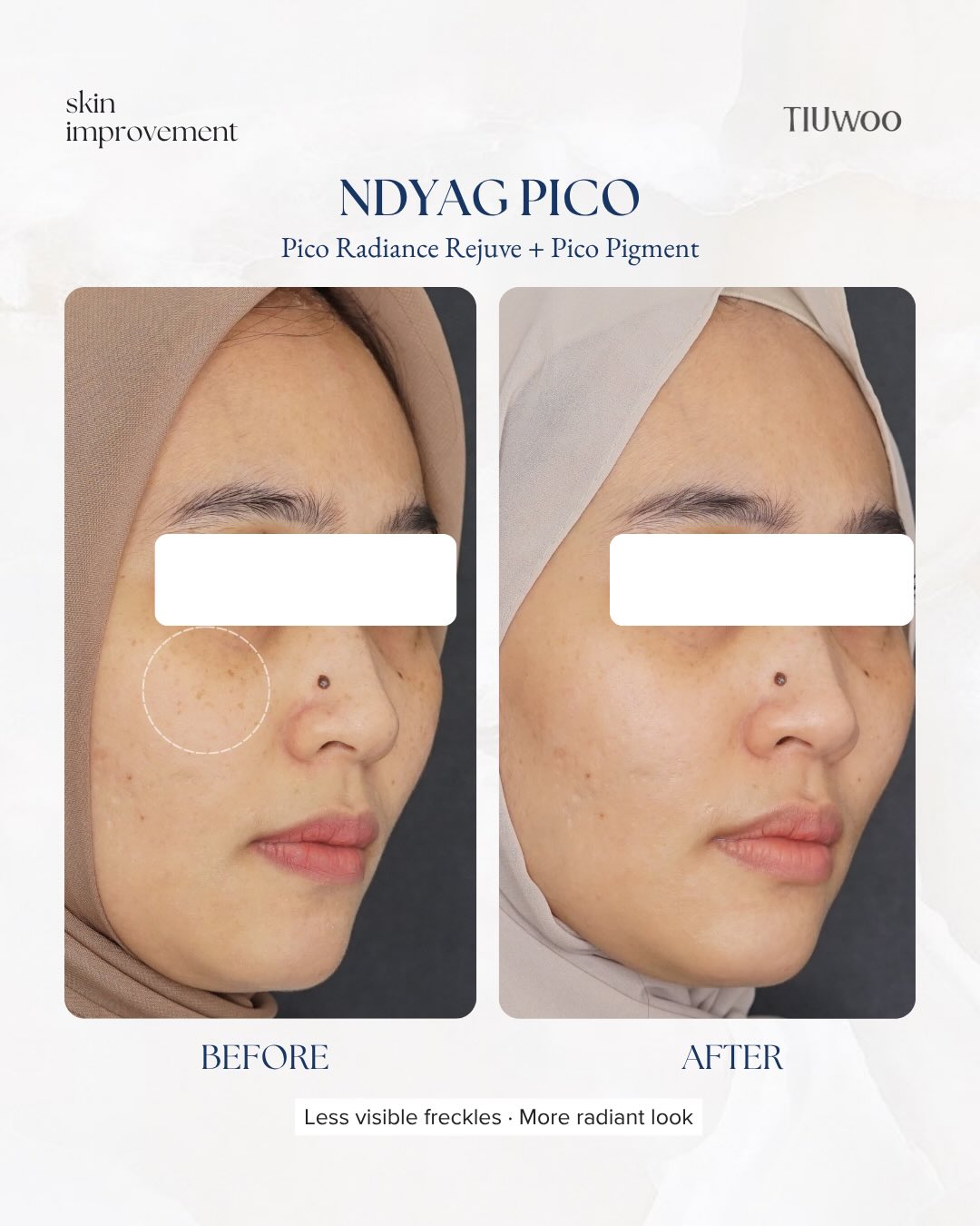 Pico Pigment Control Before After