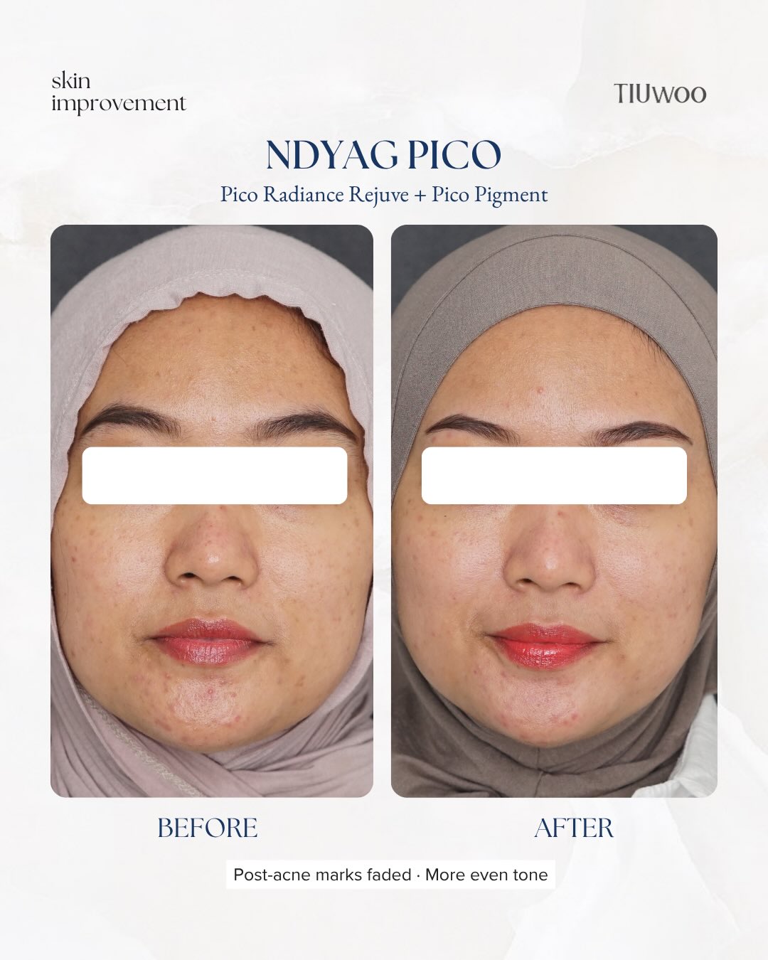 Pico Radiance & Rejuve Before After
