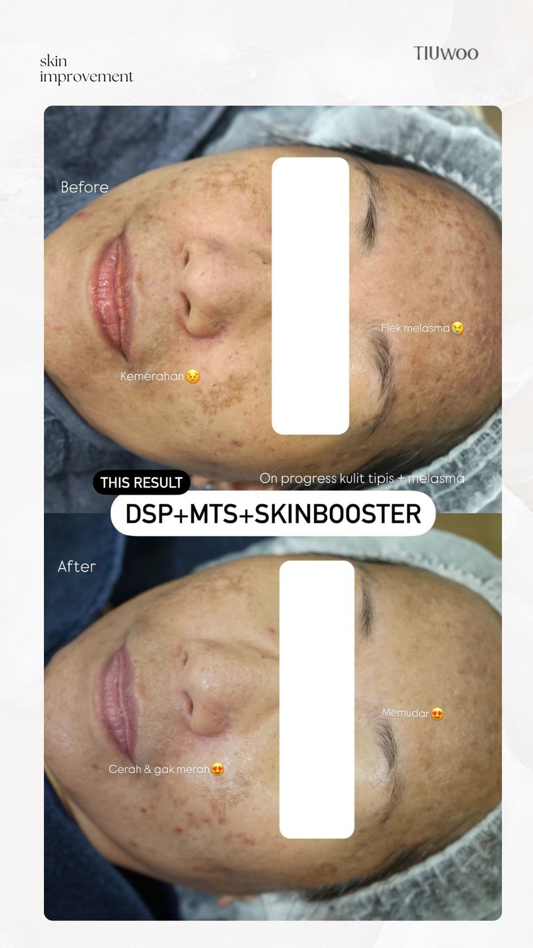 Spotless Stamp Skin Booster Before After