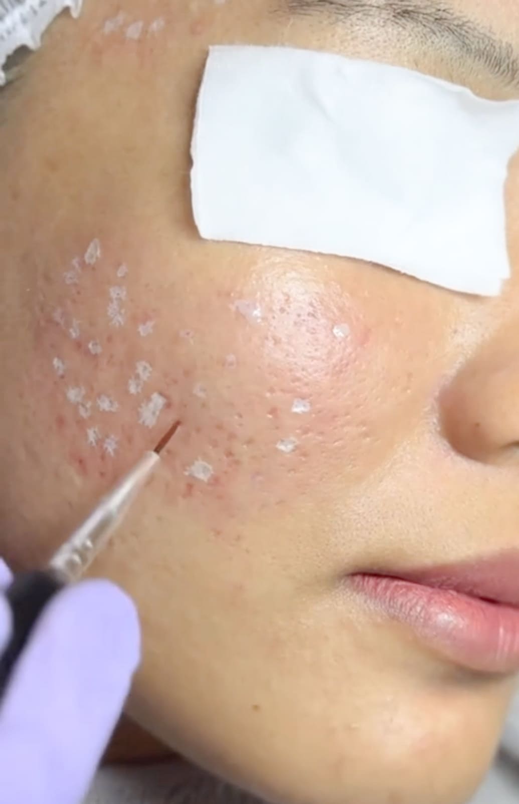 Treatment TCA Cross ini berfungsi mengangkat scars ice pick yang sulit disembuhkan oleh metode scars lain.